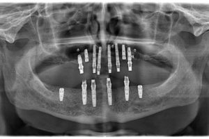 implantacia-07