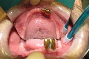 implantaty-01