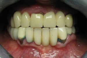 implantaty-02