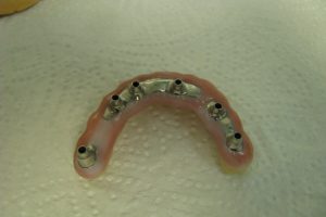 implantaty-07