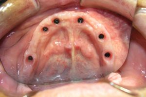 implantaty-09