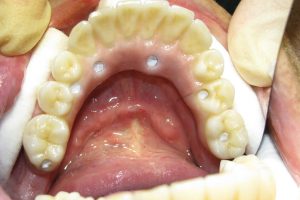 implantaty-10