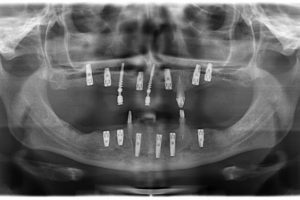 implantaty-11